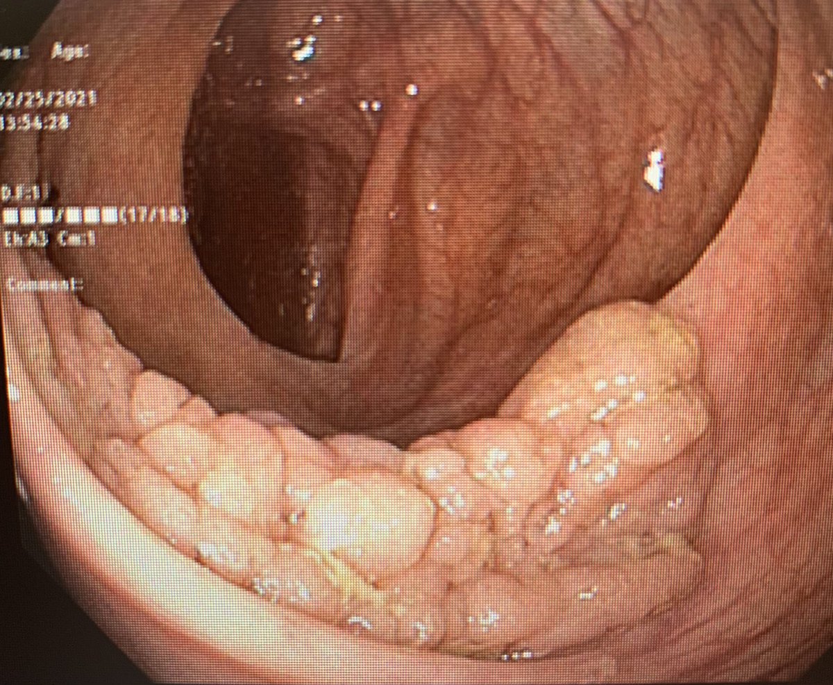 IAndalib's tweet photo. Endoscopic mucosal resection of a 70mm colon polyp that was found on a screening colonoscopy of an asymptomatic 48 year old female! Colon cancer can be prevented if you screen! If you are 45 or older get screened! Dont wait!
#coloncancerawareness  #mountsinaisouthnassau https://t.co/atEo8GZADi