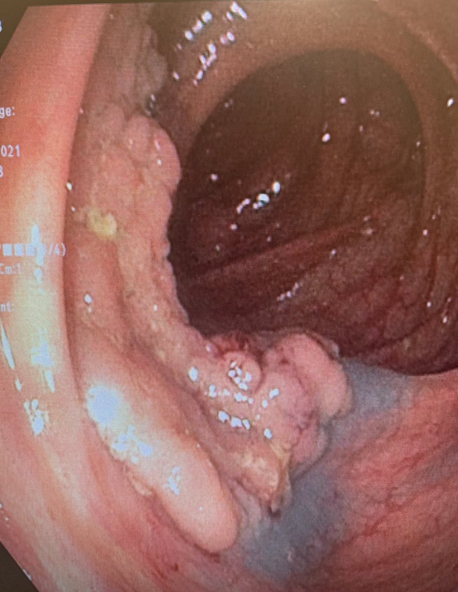 IAndalib's tweet photo. Endoscopic mucosal resection of a 70mm colon polyp that was found on a screening colonoscopy of an asymptomatic 48 year old female! Colon cancer can be prevented if you screen! If you are 45 or older get screened! Dont wait!
#coloncancerawareness  #mountsinaisouthnassau https://t.co/atEo8GZADi