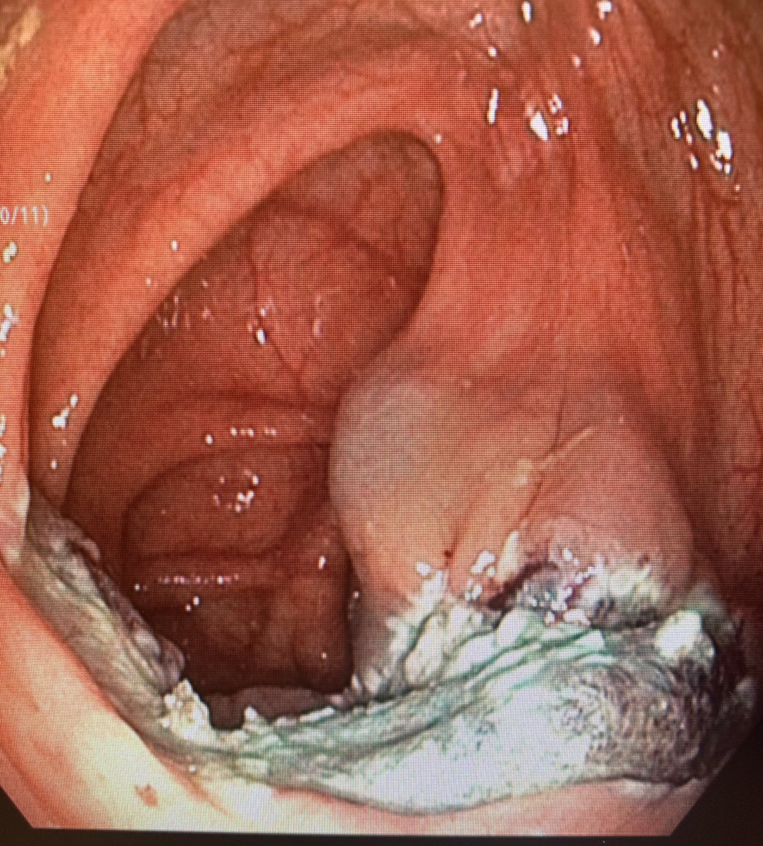 IAndalib's tweet photo. Endoscopic mucosal resection of a 70mm colon polyp that was found on a screening colonoscopy of an asymptomatic 48 year old female! Colon cancer can be prevented if you screen! If you are 45 or older get screened! Dont wait!
#coloncancerawareness  #mountsinaisouthnassau https://t.co/atEo8GZADi