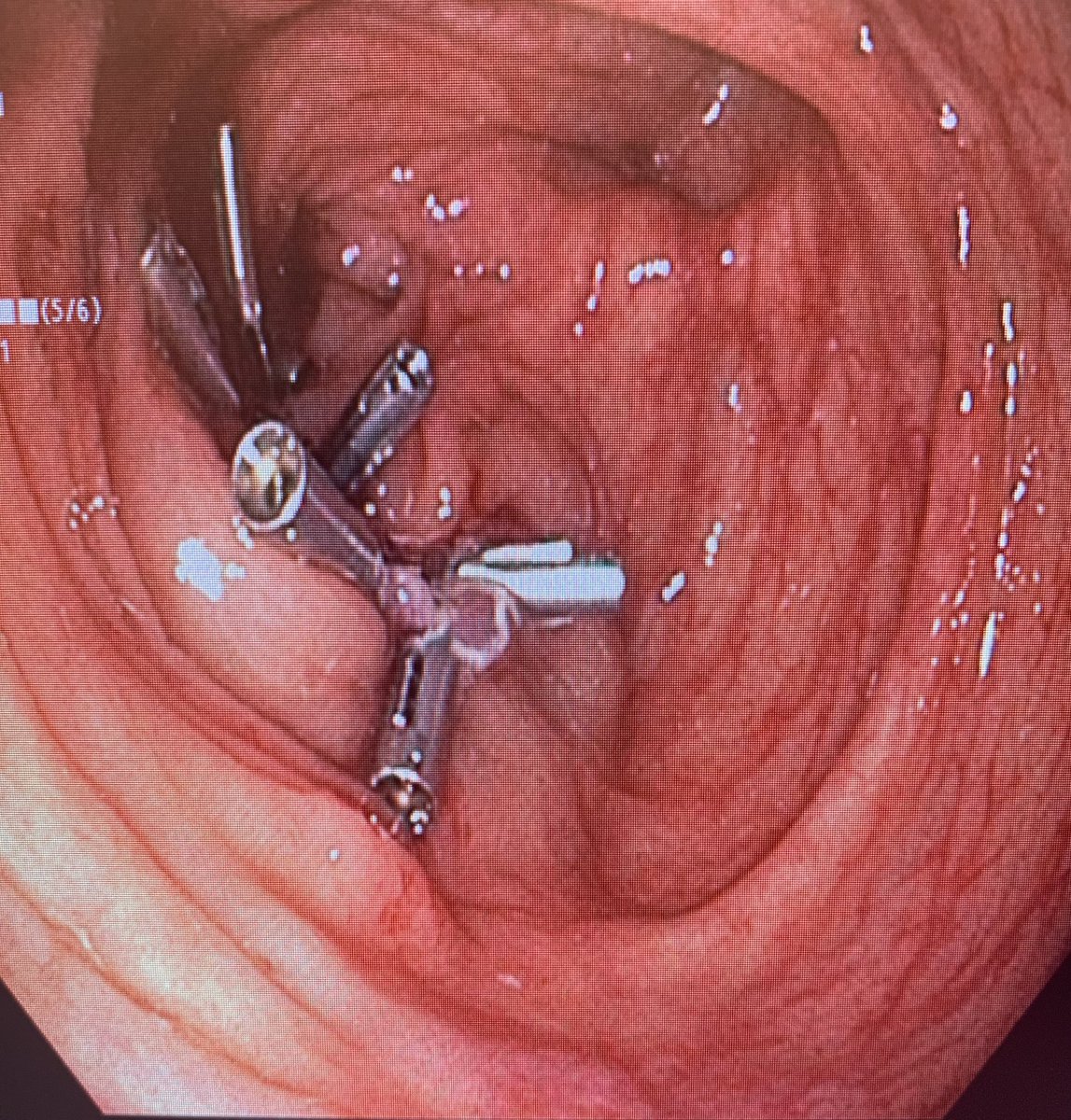 IAndalib's tweet photo. Endoscopic mucosal resection of a 70mm colon polyp that was found on a screening colonoscopy of an asymptomatic 48 year old female! Colon cancer can be prevented if you screen! If you are 45 or older get screened! Dont wait!
#coloncancerawareness  #mountsinaisouthnassau https://t.co/atEo8GZADi