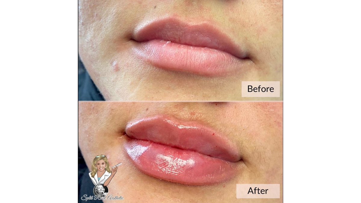 SplitRockAesIns's tweet photo. Who wants 𝐁𝐎𝐋𝐃 lips for your 𝐁𝐨𝐬𝐬 𝐁𝐚𝐛𝐞 💪ways?
Have you entered our Lip 👄 Giveaway contest on Instagram?

𝐇𝐞𝐫𝐞’𝐬 𝐭𝐨 𝐒𝐓𝐑𝐎𝐍𝐆 𝐖𝐨𝐦𝐞𝐧 𝐞𝐯𝐞𝐫𝐲𝐰𝐡𝐞𝐫𝐞..GET IT!

Split Rock Aesthetic Institute
☎️ Phone: (203) 831-8029 https://t.co/Rb5mDWyl0v