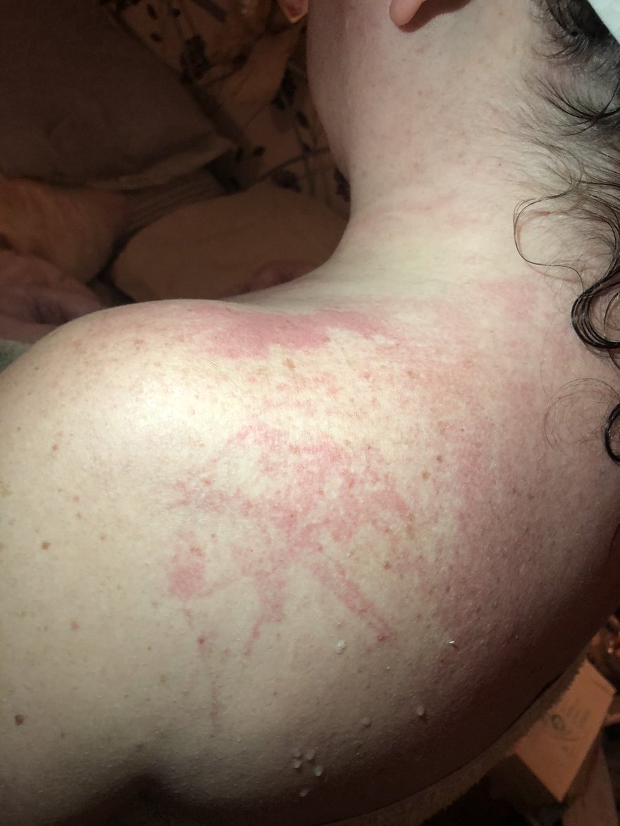 jo_cater's tweet photo. Pls b careful with @LOrealParisUK    8 Second Wonder Water.Ive bn burnt but they’ll give me £9.99 back.Customer Service is awful &amp; their ‘Coz ur worth it’ is a lie-they dont https://t.co/53D8JdIeGR so upset abt it so pls be careful if u use it.I’ll nvr buy @LOrealParisUK again https://t.co/LIAvMTQNeO