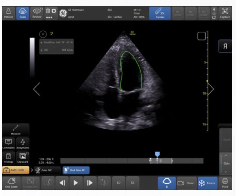 costa_pocus's tweet photo. Unlike the other guys “auto EF” the new #realtimeEF on the #gevenue works in realtime while scanning an apical 4 chamber. Scan and go! #echofirst #acep #aium #criticalcareultrasound #SCCM #POCUS #FOAMed https://t.co/9WKeAwrPNC