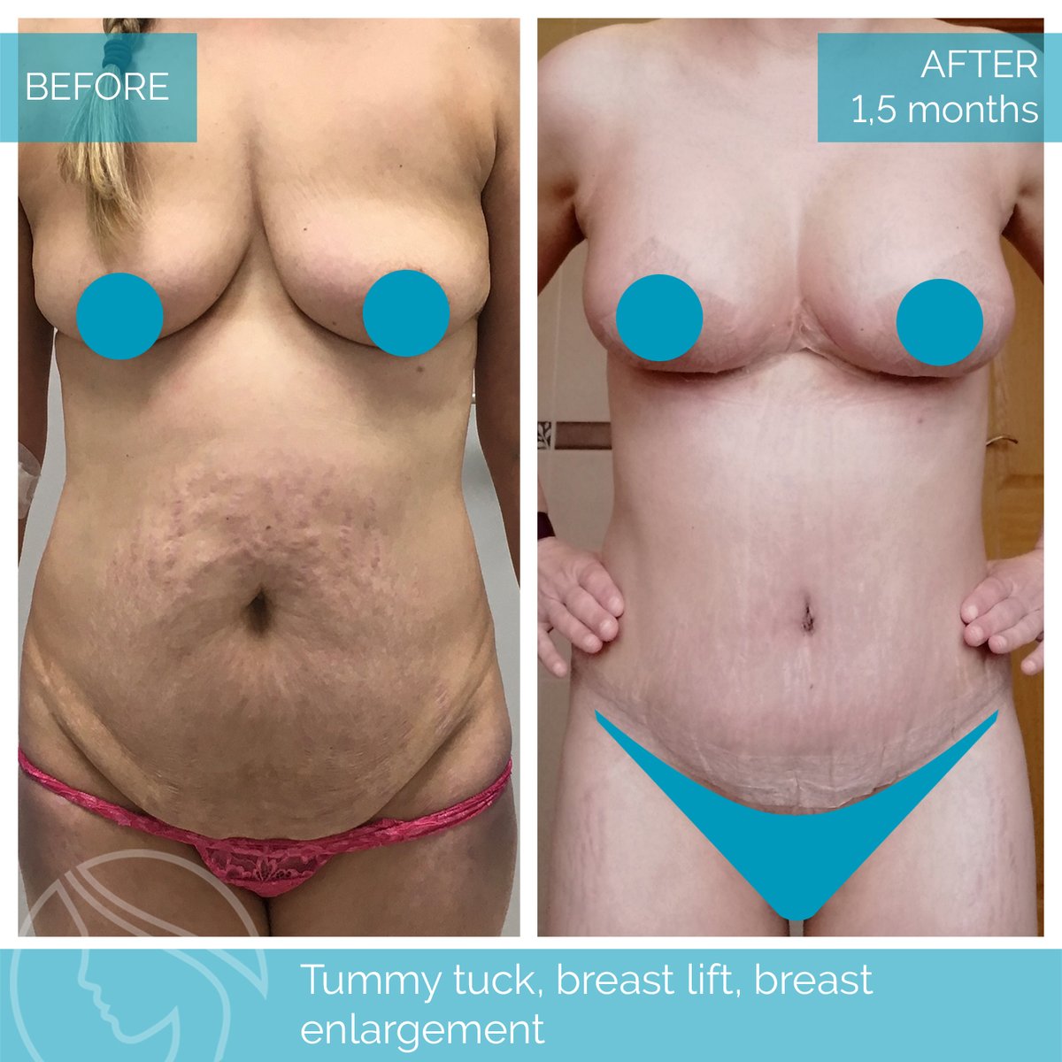 Nordesthetics Clinic on X: #Mommymakeover is a combination surgery that  usually consists of #abdominal and #breast correction. This surgery is one  of the most popular ones, as it is typically performed when