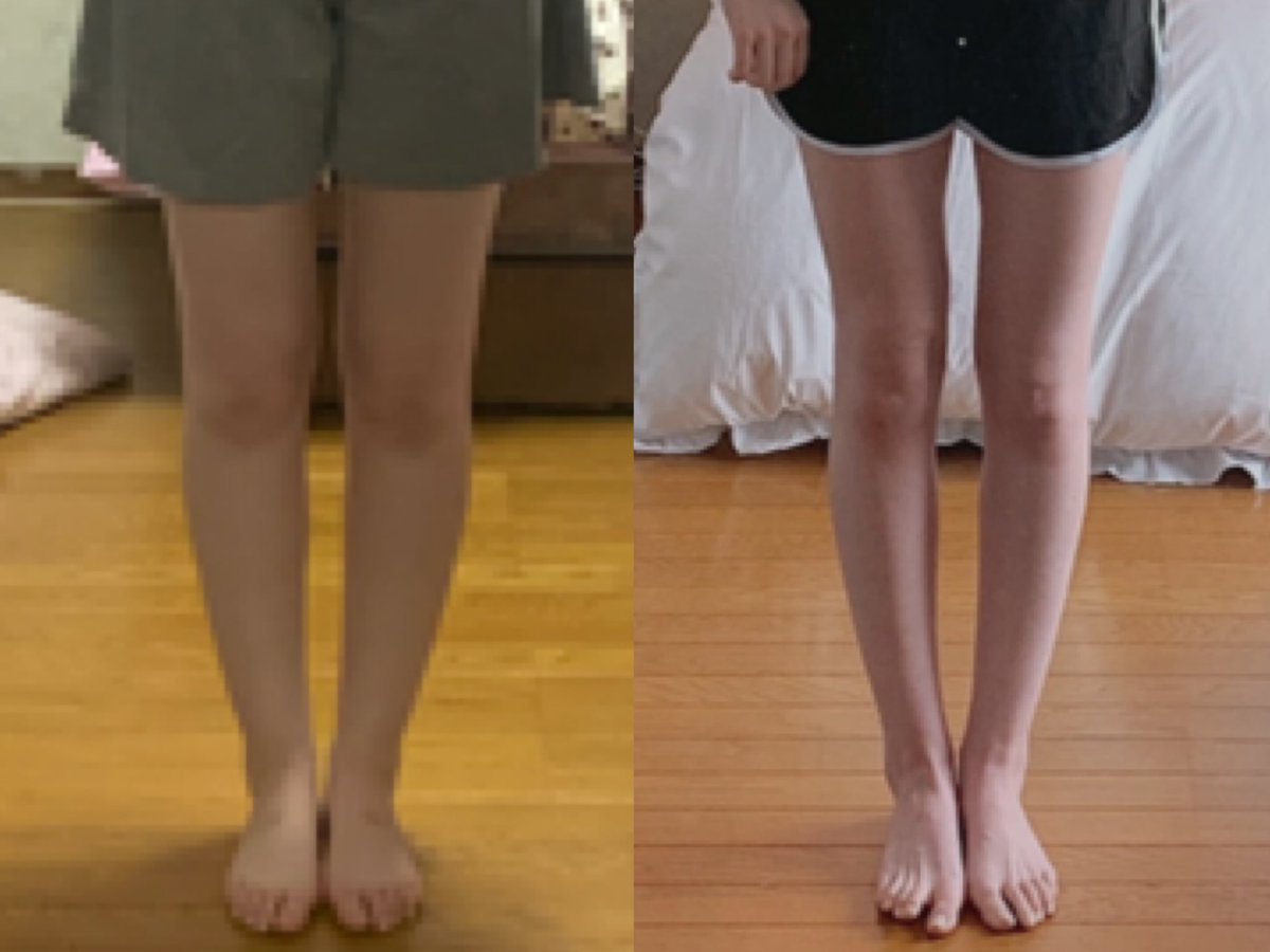 Muni 脚の歪み気になるけど少しすっきりしたかな 脚痩せは難しい ゆるーく脚パカと筋膜リリースとストレッチはずっとやってる ダイエットビフォーアフター