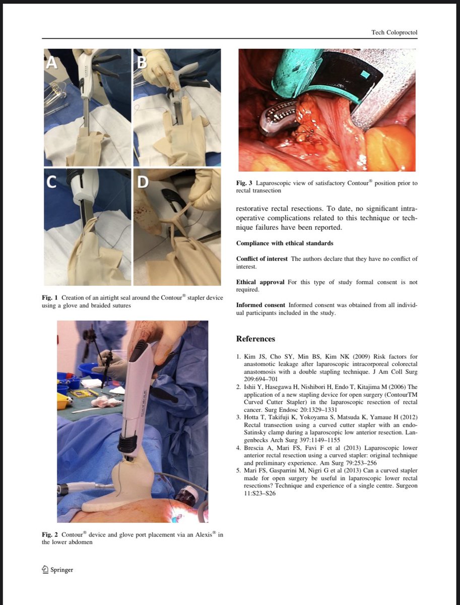 anil_keshava's tweet photo. @ScottRSteeleMD @UniversityLeeds @ACPGBI @JGColorectal @jim_tiernan Using the fingers of the glove between the shaft and the metal rod of the contour can prevent air leak when pneumoperitoneum is re established. https://t.co/NNRLucPMqM