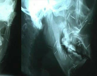 kortugi_ngetwit's tweet photo. Kadang dokter gigi mengetahui rahasia terbesarmu:
SUSUK!!!

Kira-kira, di luar negeri ada susuk ga ya? Apa yang terjadi jika dirawat dokter luar negeri yang tidak pernah tahu teknologi berkearifan lokal ini? https://t.co/YfAo4YXRzD