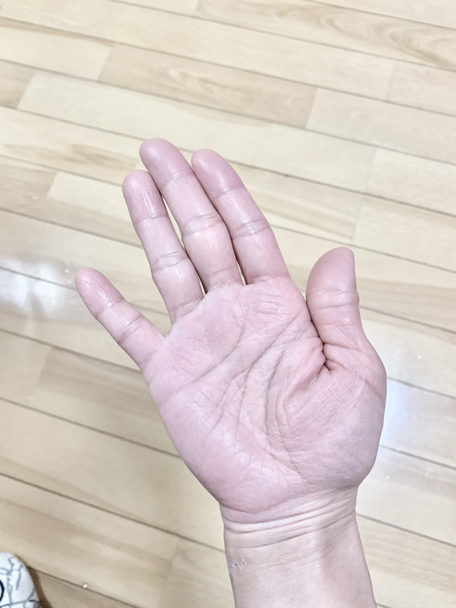 セラ 肘が痛い 最近頻繁に肘が痛い 伸ばしっぱなしも曲げっぱなしも寝起きもスマホいじってても ジワーっと痛くなってズキズキして小指の感覚が無くなってくる 小指ピシッと引っ付けられなくなってきた 肘部管症候群 神経移行術後約3年 T