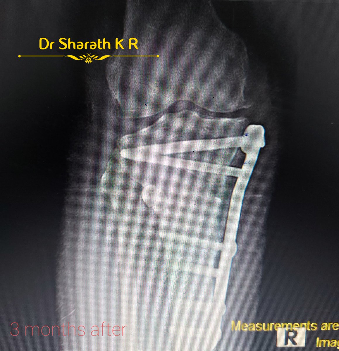 RamanathSharath's tweet photo. Medial biplane opening osteotomy with meniscus root repair. Consecutive x rays at monthly intervals. patient is walking FWB now .#HTO #meniscusrootrepair #knee #kneedoc #ortho #drsharath https://t.co/4FlSs2Nx8O