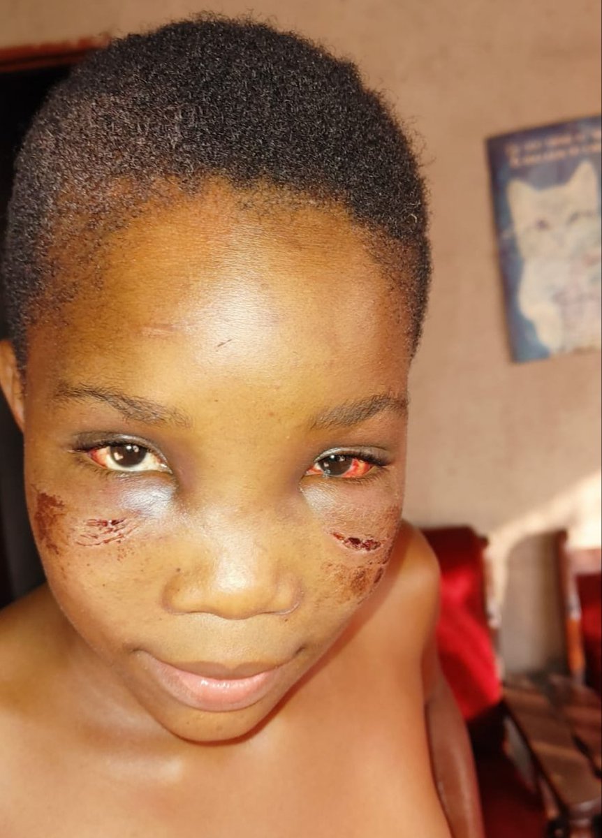 NoxoloD24172309's tweet photo. #JusticeforPhephile #GBV #EFFAssaultCase 

My 13 year old sis was brutally beaten and assaulted at Nhlazatshe no4 (Mantjotjombeni) by a guy named Siphosethu and his mother . The guy is nurse by profession, he works at Embhuleni hospital. https://t.co/saRp7lfrC5