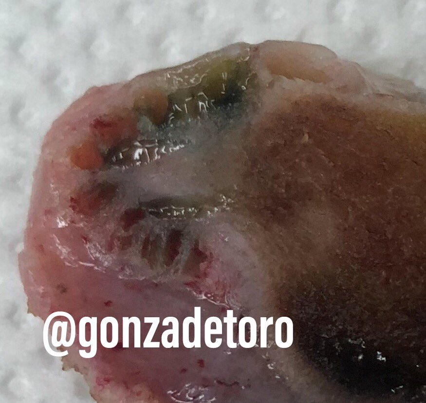 Gonzalo De Toro (@gonzadetoro) on Twitter photo I like when you are able to made the dg in the grossing table #GIPath #pathology #surgpath <a href="/JMGardnerMD/">Jerad Gardner, MD</a> <a href="/TheKarenPinto/">Karen Pinto DNB, FRCPath</a> <a href="/kriyer68/">Kalyani Bambal</a> <a href="/JCGarcesPath/">Juan Carlos Garcés</a> <a href="/USGIPS/">GIPS (GI Pathology Society)</a> <a href="/UTSW_GIpath/">UTSW GI Pathology</a> <a href="/luishcruzc/">Luis Humberto Cruz C</a> <a href="/DraEosina/">Laura G. Pastrián MD</a> <a href="/mreyesm/">Miguel Reyes-Múgica</a> <a href="/RhondaYantiss/">Rhonda Yantiss</a> <a href="/Williamson_SR/">Sean R Williamson MD</a> @CArnold_GI I like when you are able to made the dg in the grossing table #GIPath #pathology #surgpath <a href="/JMGardnerMD/">Jerad Gardner, MD</a> <a href="/TheKarenPinto/">Karen Pinto DNB, FRCPath</a> <a href="/kriyer68/">Kalyani Bambal</a> <a href="/JCGarcesPath/">Juan Carlos Garcés</a> <a href="/USGIPS/">GIPS (GI Pathology Society)</a> <a href="/UTSW_GIpath/">UTSW GI Pathology</a> <a href="/luishcruzc/">Luis Humberto Cruz C</a> <a href="/DraEosina/">Laura G. Pastrián MD</a> <a href="/mreyesm/">Miguel Reyes-Múgica</a> <a href="/RhondaYantiss/">Rhonda Yantiss</a> <a href="/Williamson_SR/">Sean R Williamson MD</a> @CArnold_GI