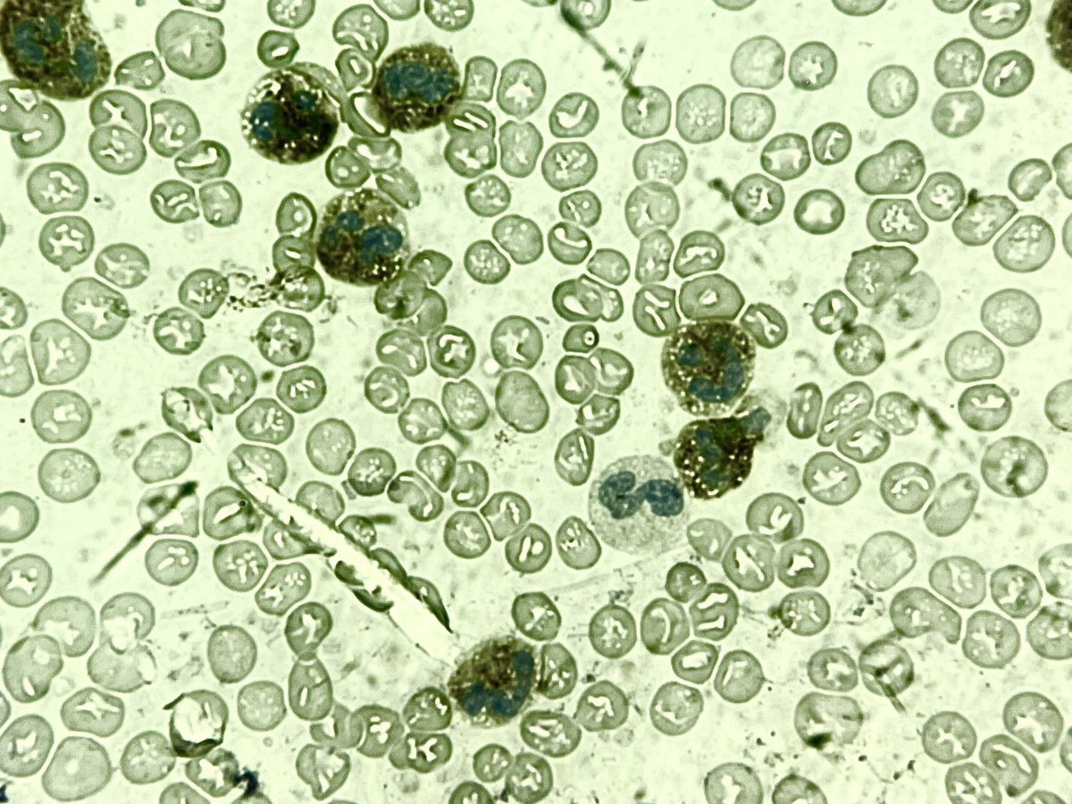 NidhinMd's tweet image. How much will you score this LAP? #PathTwitter #twitterpath #pathresident #hemepath #hematology #hematopath