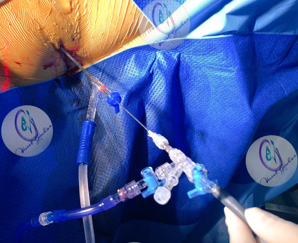 DocGauhar's tweet photo. @thomastailly @KARLSTORZUro @rocamed @HoznekAndras @BodoKnudsen @emiliani_e @YAUEndourology @OTRAXER @EndoLuminalEndo @NaeemBhojani7 @benchew22 @vdconinck @ScotlandDr @sbinhamrii @scoffonecesare @PabloNContreras @thomaschi8 I innovate :microperc set 4.8fr from @PolyDiagnost
via suction 12 fr @ClearpetraL
do #microECIRS as we had shown in @urogoldjournal
Add traxer flow @rocamed
Works 👍👍most stones
Best part :4.8fr use again for 2nd /maybe 3rd punc whilst having suction .HP popdusting is a breeze https://t.co/QuXmRbl2zP