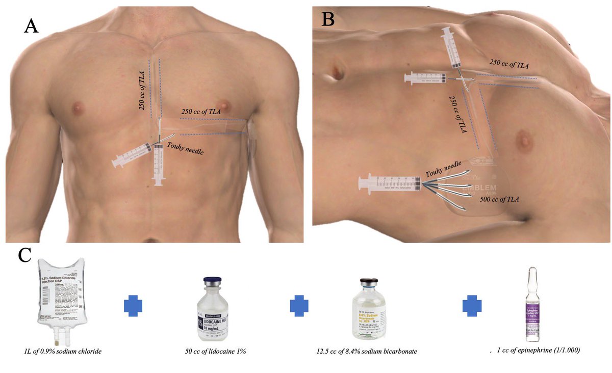 JorgeERomeroMD's tweet photo. Tumescent local anesthesia is an safe and effective alternative to GA during S-ICD implantation. TLA showed dramatically shorter in-room and procedural times and less post procedural pain. https://t.co/r2Ure76C9V @LuigiDiBiaseMD @DavidFBricenoMD @isabellalviz @Dr_Santangeli https://t.co/5Raq20wsty