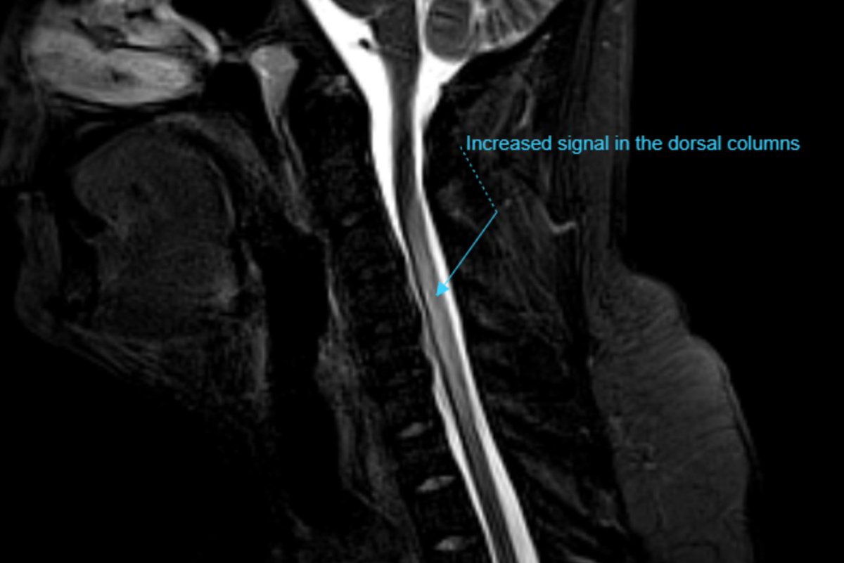 UMaryland Neuroradiology (@mdneurorads) on Twitter photo Answer:
Subacute combined degeneration due to inhalational abuse
MR: bit.ly/3l6fiSQ 👈Annotated DICOM with notes via <a href="/pacsbin/">Pacsbin.com</a>
#Radres #Neuroradiology #FOAMrad #FOAMed #NeuroRad #radiology #Radfellow #MedTwitter #Neurology #Spine #Toxicology Answer:
Subacute combined degeneration due to inhalational abuse
MR: bit.ly/3l6fiSQ 👈Annotated DICOM with notes via <a href="/pacsbin/">Pacsbin.com</a>
#Radres #Neuroradiology #FOAMrad #FOAMed #NeuroRad #radiology #Radfellow #MedTwitter #Neurology #Spine #Toxicology