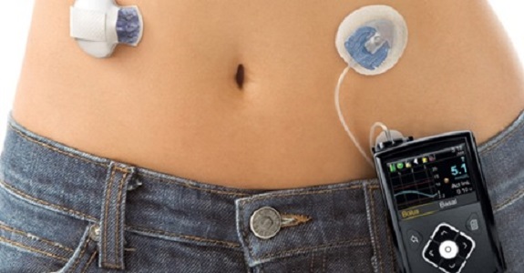 howtorelief's tweet photo. An #insulin #pump is a small device, computerized devices that some people with diabetes use to help manage their blood sugar, that is worn externally and can be discreetly clipped to your belt.
#nsulin_pump #therapy
https://t.co/SRgB68ErqV https://t.co/pob5yFD8Iy