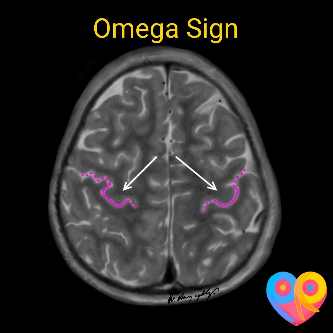 Hand motor cortex is located in the superior aspect of precentral gyrus ...