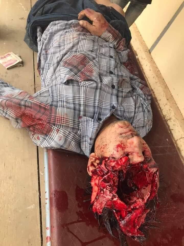 AoungAung23's tweet photo. @KenRoth @Markkyaw Also today, mying, Myanmar 
TW//blood https://t.co/YkXFC5ObTc