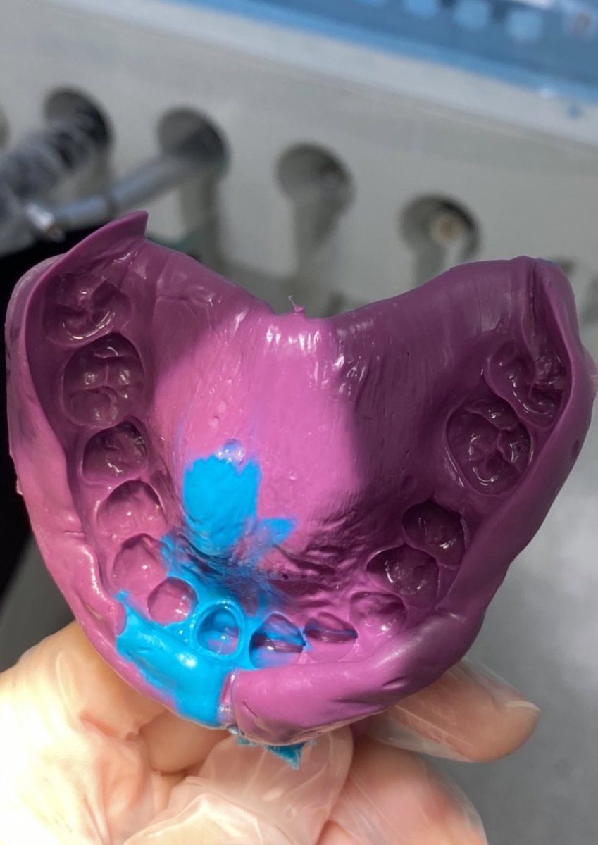 ShathaKr's tweet photo. Done with the CE perfectly 💯

Final impression + Provisional crown on tooth #11 https://t.co/lQEk3qEDP9