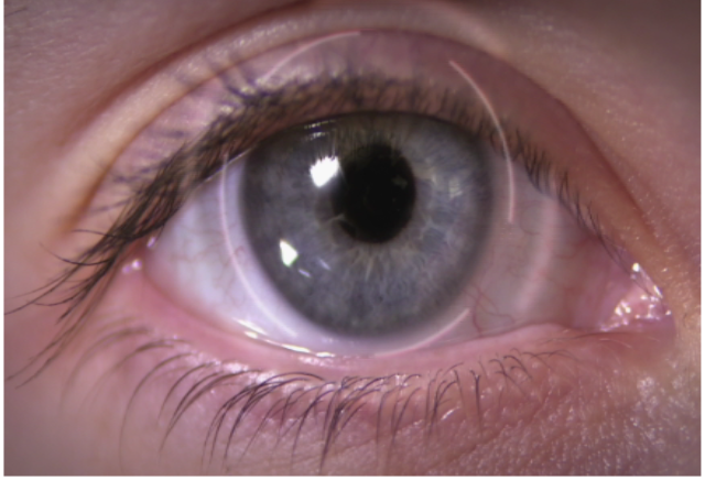 ElisirTv's tweet photo. Essere presbite significa avere difficoltà nella visione per vicino. La #presbiopia è legata all'età, e si manifesta quando il cristallino perde parte della sua elasticità, indurendosi ed impedendogli di cambiare forma e di mettere a fuoco gli oggetti vicini. #elisir https://t.co/Y6tCRmKULk