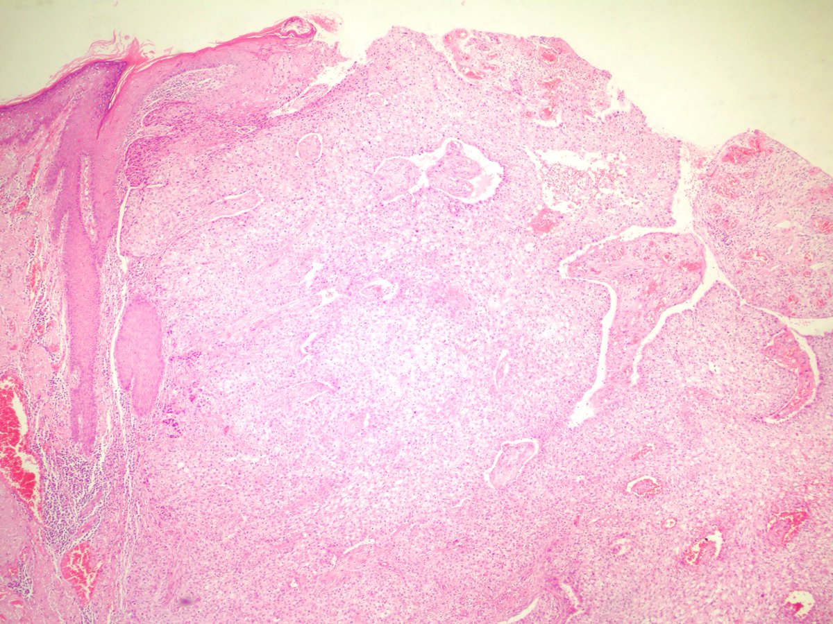 glinglerimek's tweet photo. #sebaceous #carcinoma #atypia #mitosis #invasion #skin #dermatology #dermpath my college’s case https://t.co/3c229ViJx5