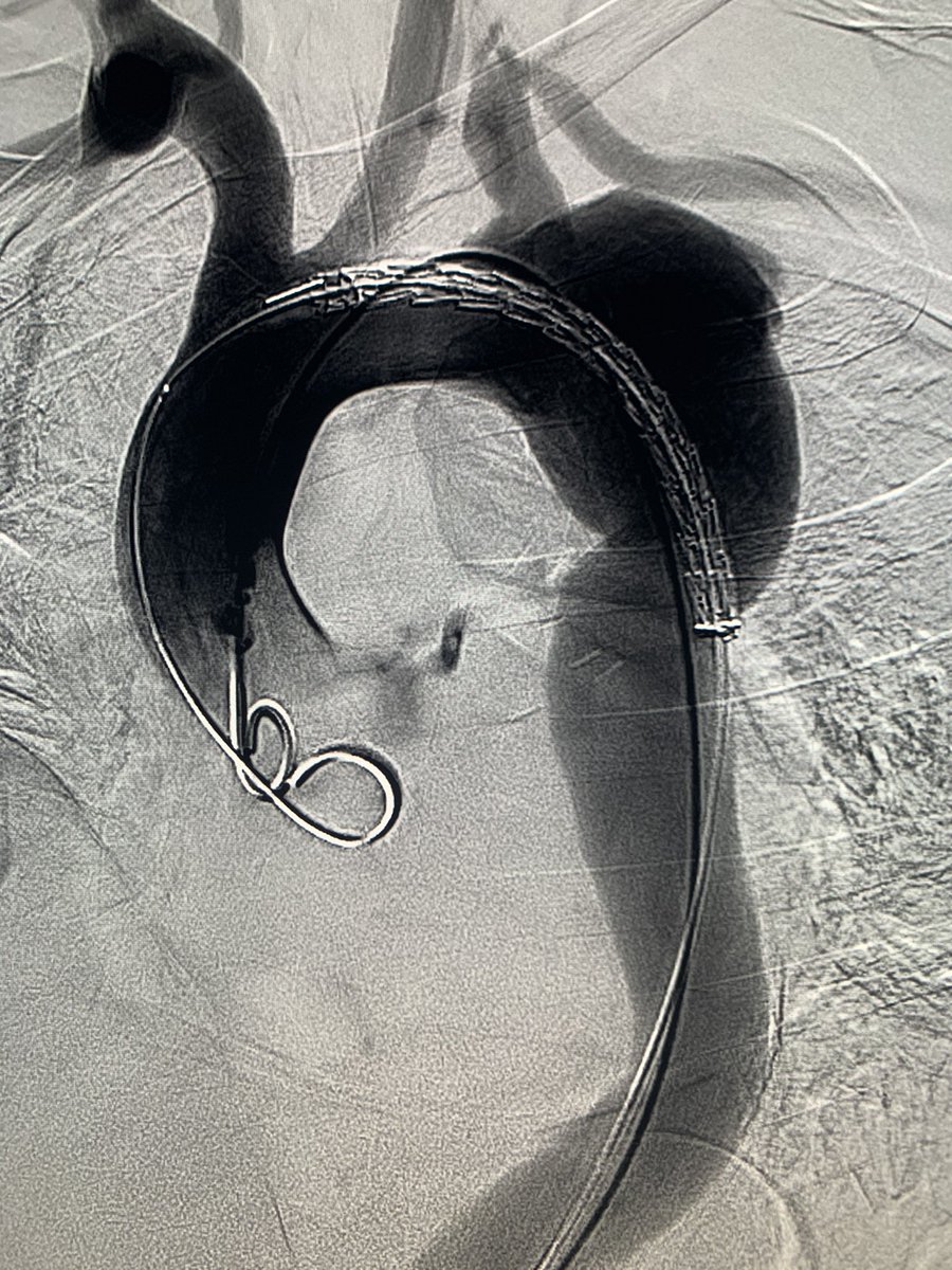 banderaldhafery's tweet photo. Thoracic aortic aneurysm (TAA) is uncommon in our  practice , we see more of AD and TAI #aorticaneurysm #endovascular #irad #aortic 
#TEVAR performed totally via percutaneous approach���� https://t.co/V6FS5wXyo1
