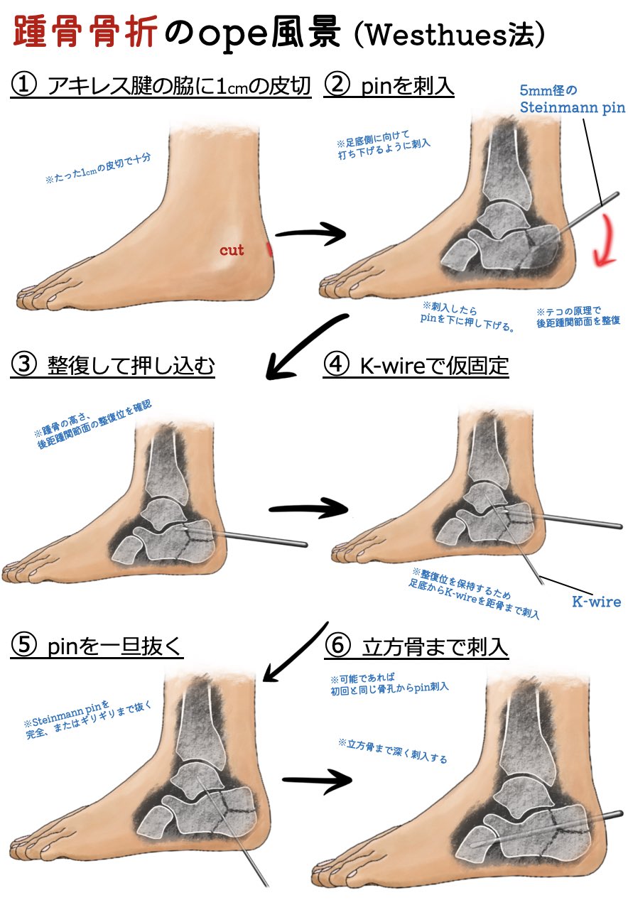 ユジカワ 整形dr イラストレーター 踵骨骨折は 外側プレートを用いることもあるが 腫れやすく傷が治りにくいため 骨折型が許せばこちらを行っている Pinは皮膚から出ている状態で 4週後に麻酔も無しに軽く抜ける Ope時間も30分程度だし 不思議な