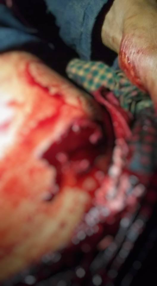 tw // blood wound

A civilian who was banging pots and pans in his home compound got shot near abdomen with live bullet by terrorists in Heho city, Kalaw region. About 4 civilians were arrested as well.
STOP ONSLAUGHT

#WhatsHappeningInMyanmar  #Mar11Coup