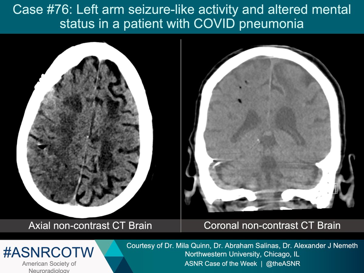 The American Society Of Neuroradiology Asnrcotw 76 Hx Lt Arm Sz Like Activity Alt Mental Status In Pt W Covid Pna Case C O Drs Milaquinnmd Salinas And Nemeth No Spoilers Only The American Society Of Neuroradiology Asnrcotw 76 Hx Lt Arm Sz Like Activity Alt Mental Status In Pt W Covid Pna Case C O Drs Milaquinnmd Salinas And Nemeth No Spoilers Only