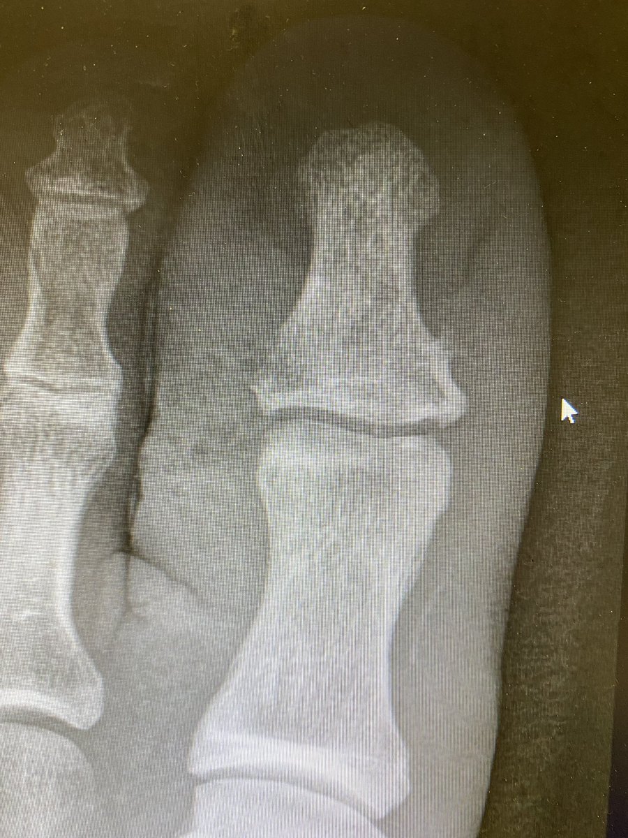 Prash Vas (@prashvas) on Twitter photo If you have a diabetes foot problem + recently had the #COVID #vaccine , do let your #foot team know if feeling unwell/ ‘flu’ like.
It could be a foot infection rather than a reaction to the jab. #checkitout
@CollegePodiatry <a href="/Martinfox2000/">Martin Fox</a> <a href="/CoxAlisoncox/">Alison Cox ▪️DSN 💙💛</a> <a href="/_diabetes101/">Team Diabetes 101</a> <a href="/svig2/">Stella Vig #NHS</a> If you have a diabetes foot problem + recently had the #COVID #vaccine , do let your #foot team know if feeling unwell/ ‘flu’ like.
It could be a foot infection rather than a reaction to the jab. #checkitout
@CollegePodiatry <a href="/Martinfox2000/">Martin Fox</a> <a href="/CoxAlisoncox/">Alison Cox ▪️DSN 💙💛</a> <a href="/_diabetes101/">Team Diabetes 101</a> <a href="/svig2/">Stella Vig #NHS</a>