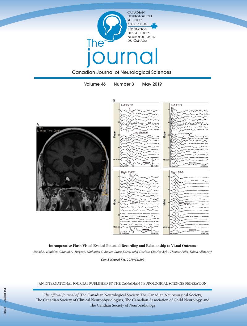 CNSFNeuroLinks's tweet image. Intraoperative Flash Visual Evoked Potential Recording and Relationship to Visual Outcome
DOI: doi.org/10.1017/cjn.20…
#CJNS May 2019 Cover Highlight
#Flashvisualevokedpotential #Visualfunction #Intraoperativemonitoring #transientchange #CNSF @CambUP_Psych