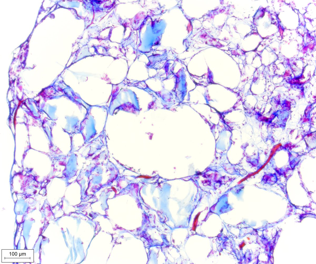 Interested in bioprinting and the host response to lung derived 3D printed hydrogels? 🫁 Come listen to me talk about a recent project from the @DWagnerLab in the Young Investigator Session tomorrow 🙌🏻@EuroRespSoc #LSC2021