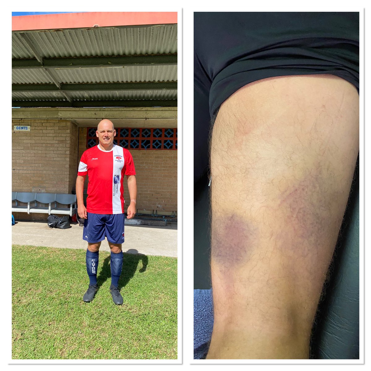 Cajaldo's tweet photo. @FigtreePhysio @_boycs @hanger50 How it started vs how it’s going https://t.co/ooklkjmneU