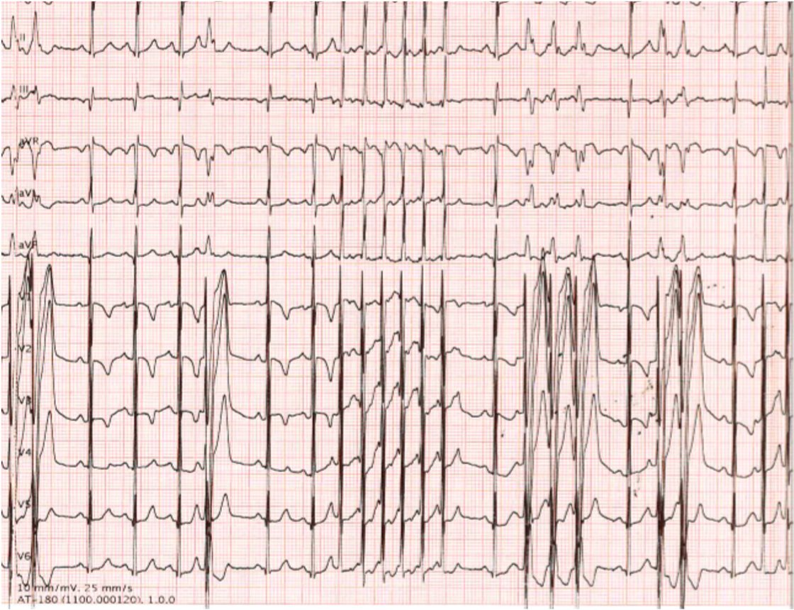 EP and Pacing LAB, HSMarta, CHULC (@ep_hsmarta) on Twitter photo Atrial tachycardia #ablation in an 8-month-old baby (9kg) with operated Berry Syndrome. Occluded femoral veins.
4F CS and 5F ablation catheters.
<a href="/smmlar/">Sergio Laranjo</a> <a href="/MMOliveira50/">Mário Oliveira</a>
#EPeeps
#EPPedCong <a href="/EPeeps_Bot/">EP_Bot</a> Atrial tachycardia #ablation in an 8-month-old baby (9kg) with operated Berry Syndrome. Occluded femoral veins.
4F CS and 5F ablation catheters.
<a href="/smmlar/">Sergio Laranjo</a> <a href="/MMOliveira50/">Mário Oliveira</a>
#EPeeps
#EPPedCong <a href="/EPeeps_Bot/">EP_Bot</a>