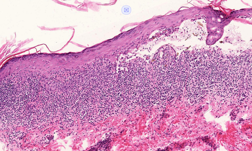 A beautiful case -What is your diagnosis? From the Sid Barsky Collection. See the digital slide here: kikoxp.com/posts/4814/pub… #dermpath #dermatology #pathology #dermtwitter #pathtwitter