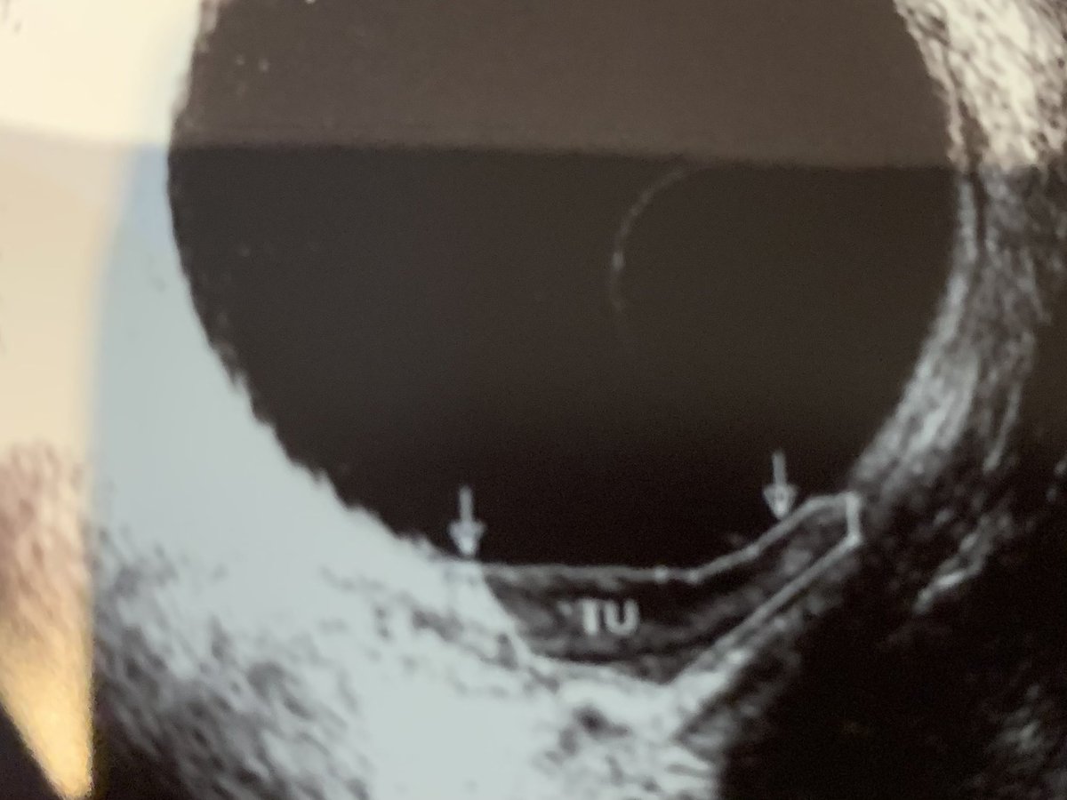 luciacolorectal's tweet photo. 3D ERUS still with a role in early rectal cancer staging  @luciacolorectal @SWexner @JNoguerasMD @josereinanramo1 @smregadas10 #rectalcancer #ColonCancerAwarenessMonth #stopcoloncancer #ascrs https://t.co/ngUpChiSYn