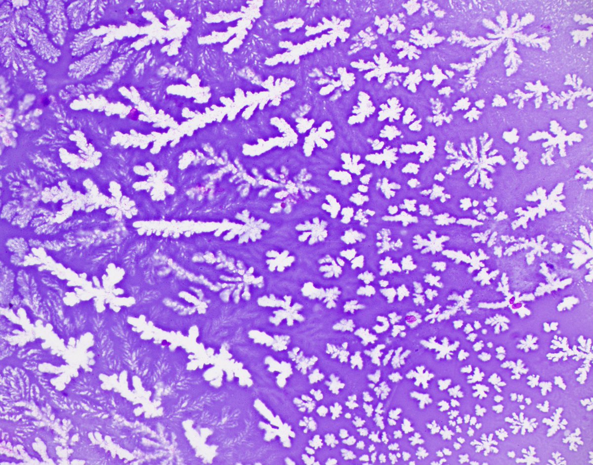 HubertLauMD's tweet image. &quot;Ferning&quot; in pancreatic mucinous cyst fluid #FNApath #CytoPath