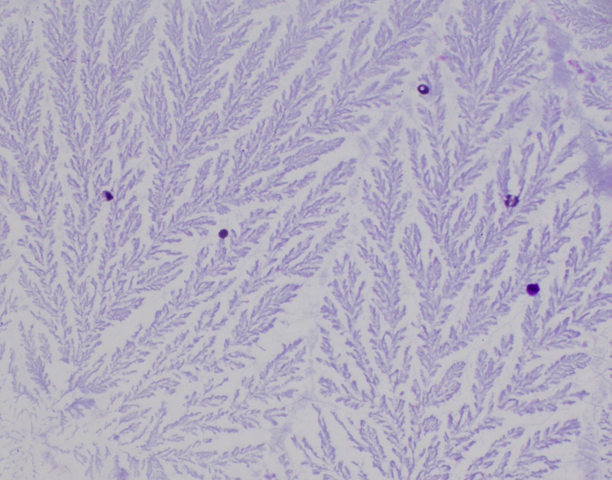 HubertLauMD's tweet image. &quot;Ferning&quot; in pancreatic mucinous cyst fluid #FNApath #CytoPath