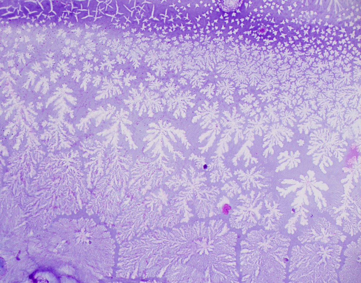 HubertLauMD's tweet image. &quot;Ferning&quot; in pancreatic mucinous cyst fluid #FNApath #CytoPath