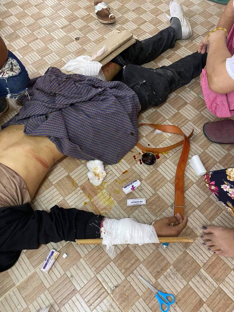 NppWin's tweet photo. 9th grader boy, a front-liner in North Dagon protest was shot in right arm and left thigh. He just got out of surgery today but he still has two more surgeries to go. How High schoolers in Myanmar are spending their youths!

UNSC ACT NOW
#WhatsHappeninglnMyanmar
#Mar12Coup https://t.co/ZtdgJLCBJI