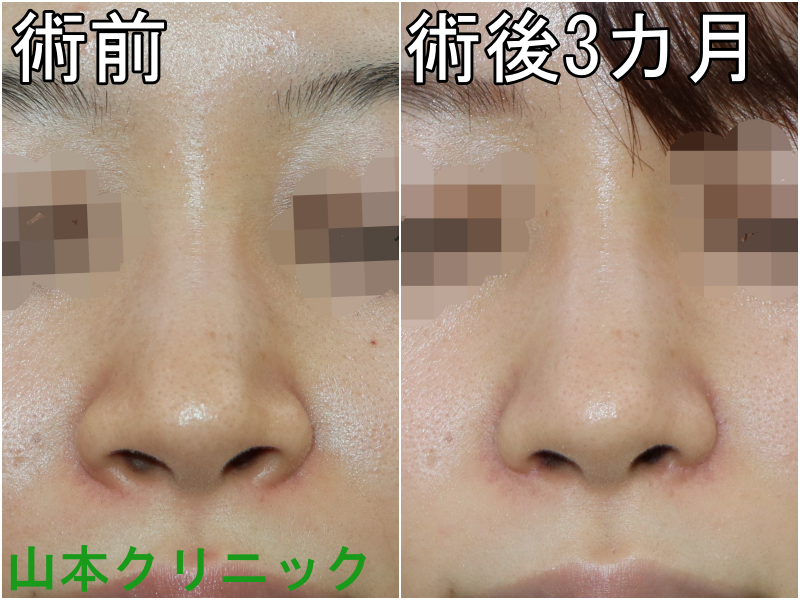 公式 山本クリニック 他院修正 当院の 小鼻縮小 という手術には内側切開 外側切開 鼻腔底形成が含まれております 小鼻の張りが小さくなり 鼻の穴の見え方の変化が分かるかと思います 斜めから見ても 何となく小鼻がスッキリしたように見えますね