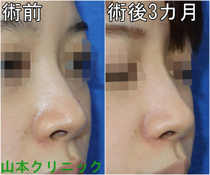 公式 山本クリニック 他院修正 当院の 小鼻縮小 という手術には内側切開 外側切開 鼻腔底形成が含まれております 小鼻の張りが小さくなり 鼻の穴の見え方の変化が分かるかと思います 斜めから見ても 何となく小鼻がスッキリしたように見えますね