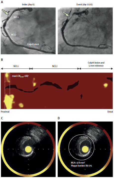Gregg W. Stone MD tweet media