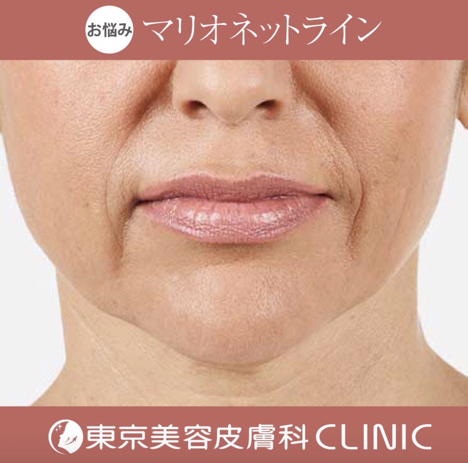 東京美容皮膚科クリニック マリオネットラインってどうやってケアするの 医療ハイフ サーマクール ウルセラ T Co N3vtsq6m0h T Co Imxmumjcm0 Twitter