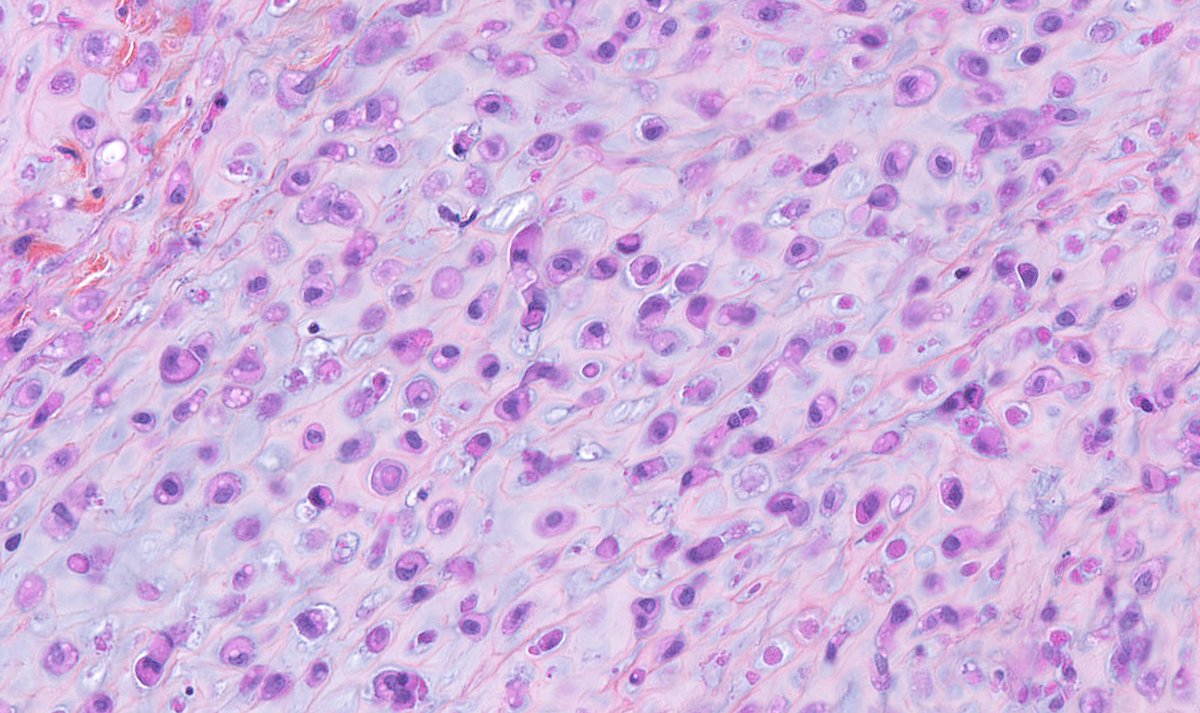 NMacagnoMD's tweet photo. Malignant cutaneous myoepithelioma : ulcerated skin neoplasm - plasmacytoid, epithelioid, spindle &amp; small undifferentiated cytology - chondroid matrix - high mitotic activity (>15.mm2) - geographic necrosis #dermpath #bstpath https://t.co/vuDcVsd2TU