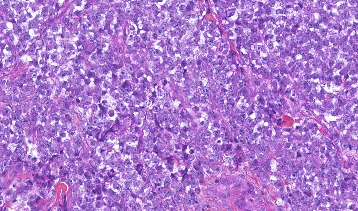 Malignant cutaneous myoepithelioma : ulcerated skin neoplasm - plasmacytoid, epithelioid, spindle &amp; small undifferentiated cytology - chondroid matrix - high mitotic activity (&gt;15.mm2) - geographic necrosis #dermpath #bstpath