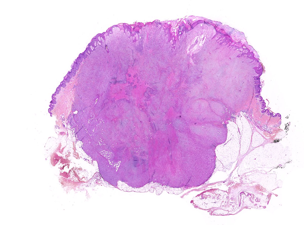 NMacagnoMD's tweet photo. Malignant cutaneous myoepithelioma : ulcerated skin neoplasm - plasmacytoid, epithelioid, spindle &amp; small undifferentiated cytology - chondroid matrix - high mitotic activity (>15.mm2) - geographic necrosis #dermpath #bstpath https://t.co/vuDcVsd2TU