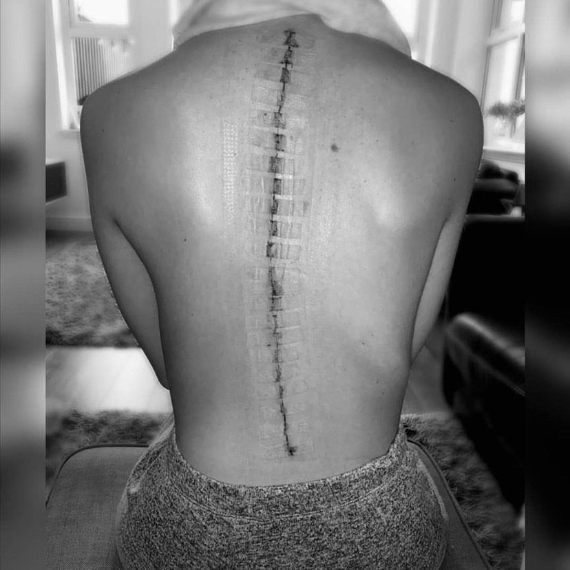 AlderHey's tweet photo. 18yo Macey 👧 was treated for scoliosis by our spinal team under the care of Dr Neil Davidson 👨‍⚕️ spinal specialist nurse Lisa 👩‍⚕️ &amp; Ward 4A. She said 🗣️ "I'm so thankful to my surgeon &amp; the team at Alder Hey who carried out my 9 hour corrective spinal operation" 💙 #FeelGoodFriday https://t.co/A1a5FBQ65u