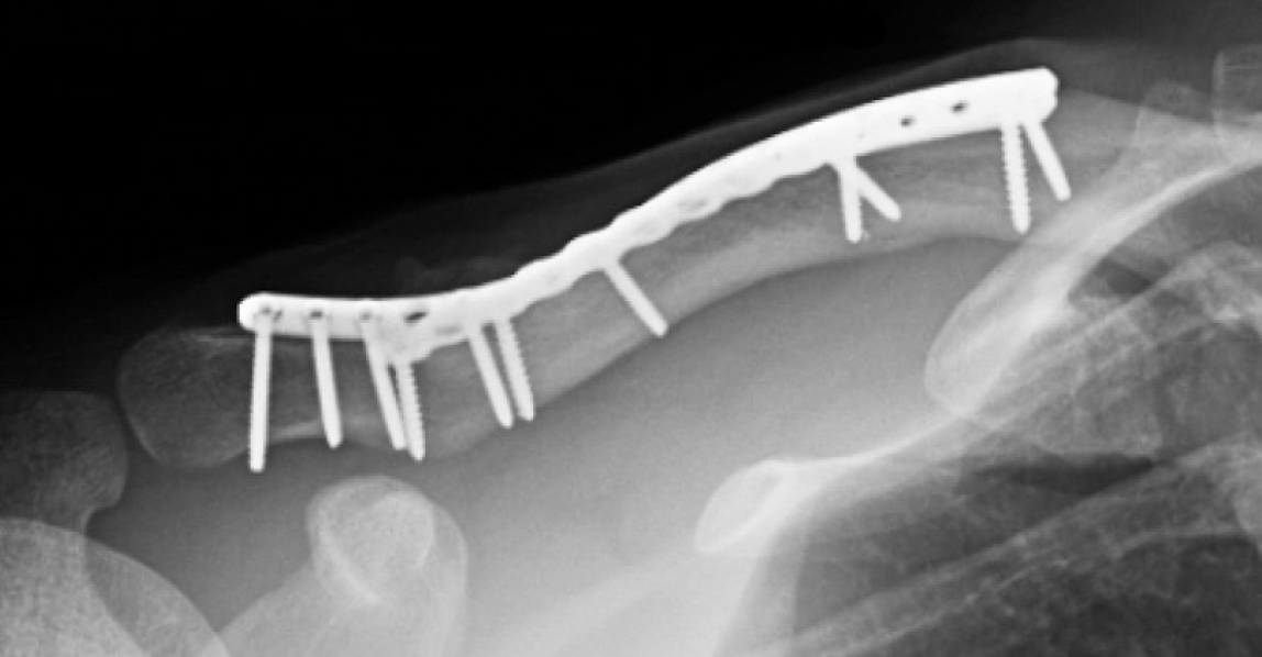 RobZondervan's tweet photo. #FractureFriday Thoracic outlet syndrome is a potential complication of clavicle #fracture, even in the setting of anatomic reduction and primary bone healing. @jbjs 
https://t.co/cS7yPwe3mS
@ORSsociety @isfrfractures #TweetTheTib https://t.co/AdtAqj0esX