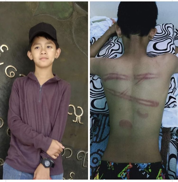 nangnyi's tweet photo. On his way to buy snacks, a ninth-grader (age around 14/15) was arrested by the police. He was badly beaten up. Beating up an innocent child for no reason is a #CrimesAgainstHumanity 
#FascistMyanmarMilitary 
#WhatsHappeningInMyanmar https://t.co/2q46j04vQW